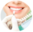 dental veneers